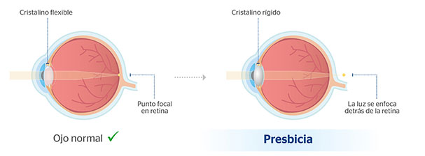 Ojo normal y ojo con presbicia 