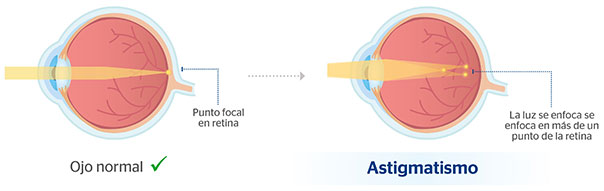 ImOjo normal y ojo con astigmatismo