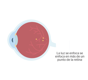 ojo con astigmatismo