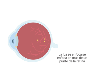 ojo con astigmatismo