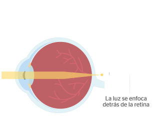 ojo con hipermetropía