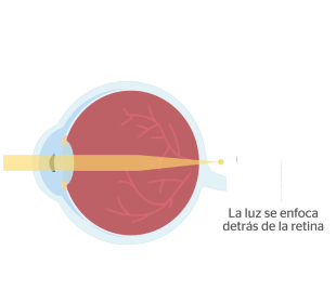 ojo con hipermetropía