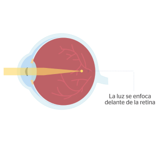 ojo con miopía