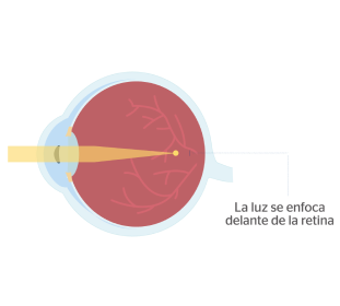 ojo con miopía