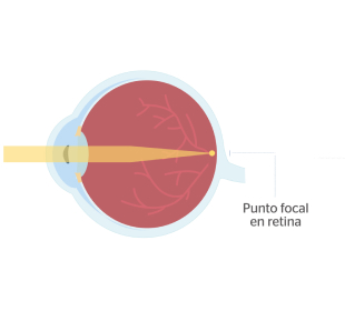 ojo normal sin miopía
