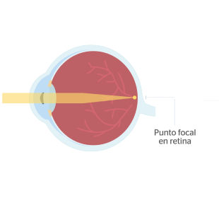 ojo normal sin astigmatismo