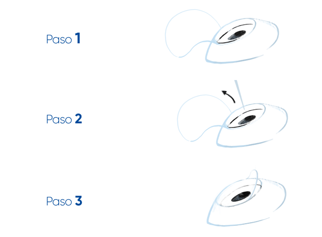 pasos cirugía Lasik