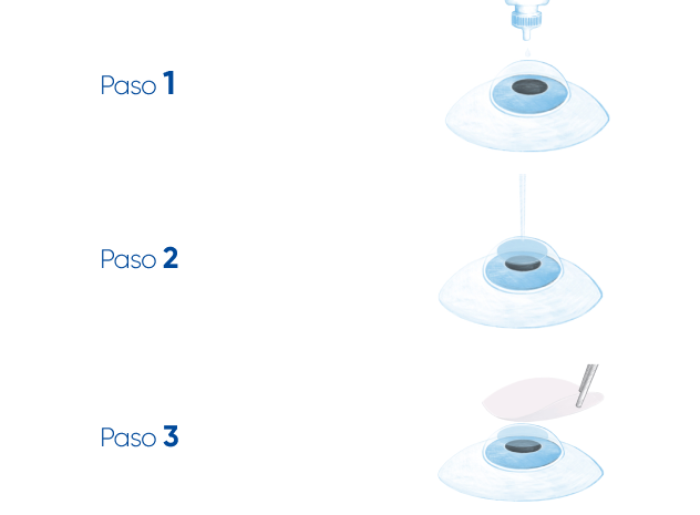 pasos cirugía Lasek