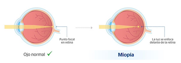 miopie de gradul I bulionul îmbunătățește vederea