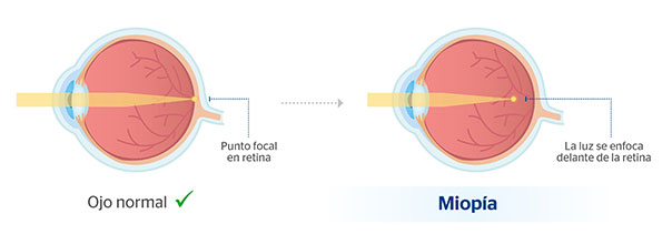 Ojo normal y ojo con miopa