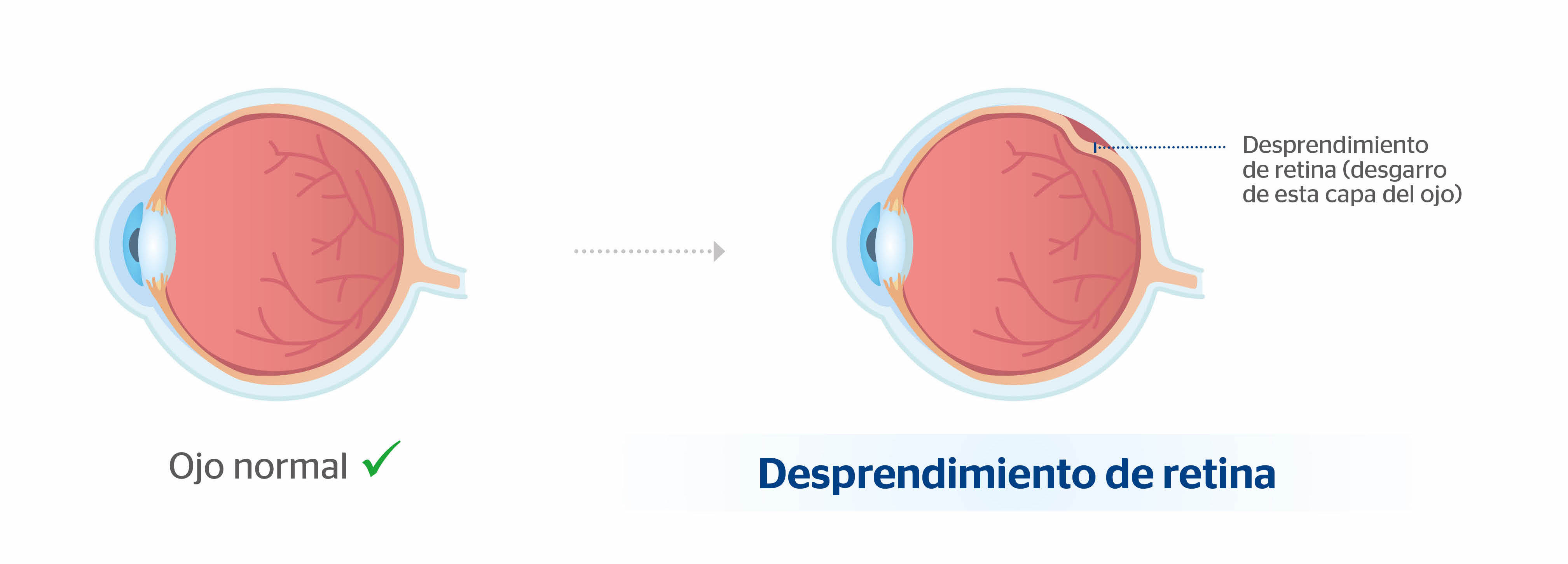 Ojo normal y ojo con desprendimiento de retina