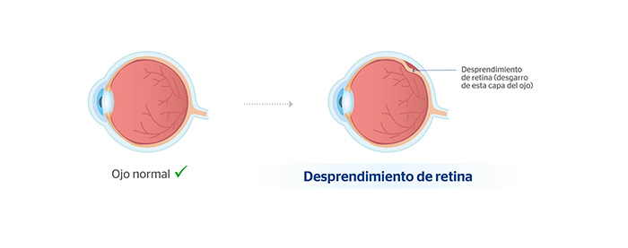 Desprendimiento de retina