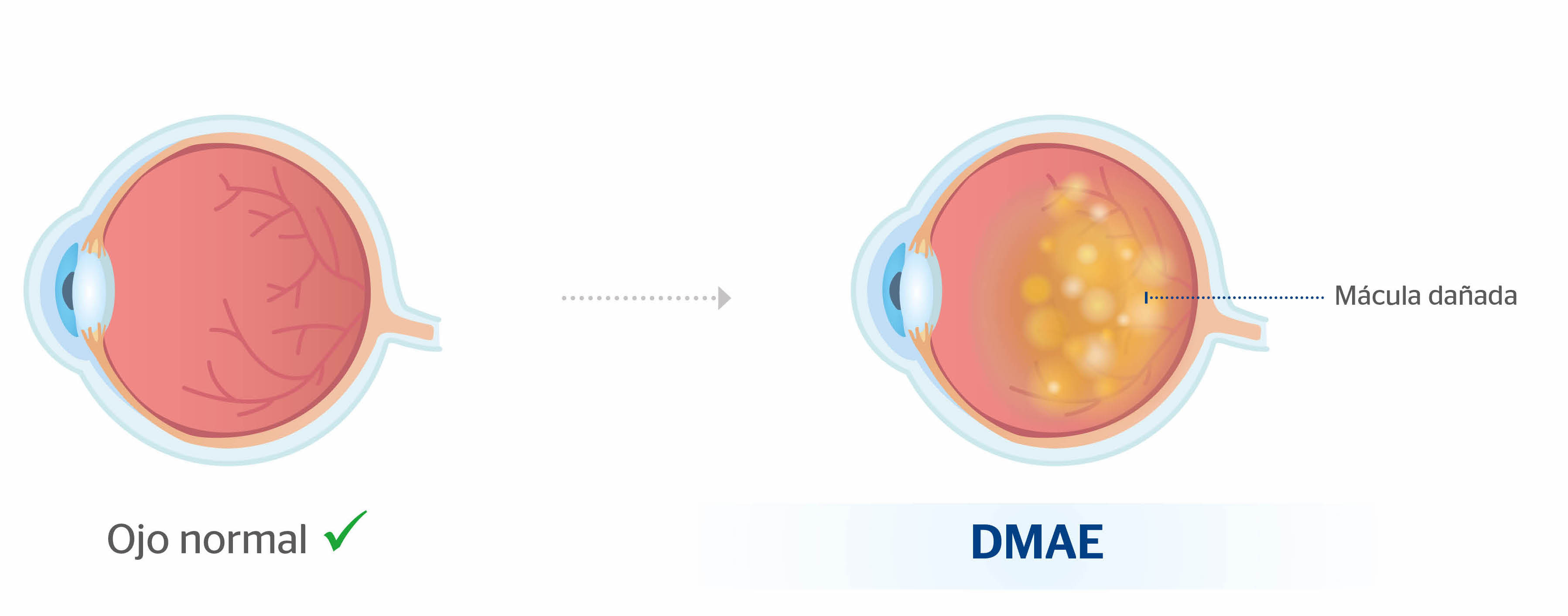 Ojo normal y ojo con DMAE