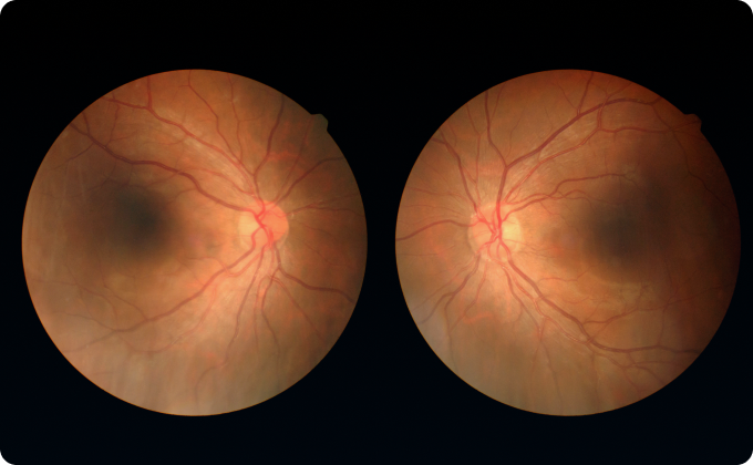 resultados OCT agujero macular