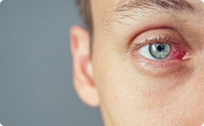 primer plano ojo paciente con derrame 