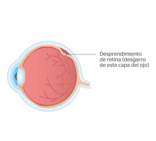 ojo con desprendimiento de retina