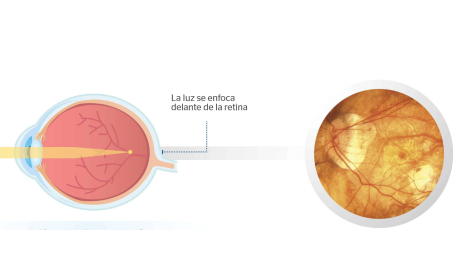 ojo con miopía magna