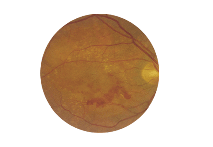 OCT de retina con DMAE húmeda o exudativa