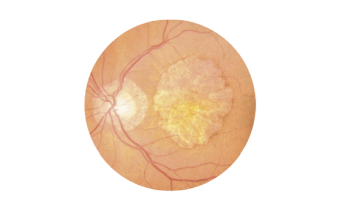 CT de retina con DMAE seca o atrófic