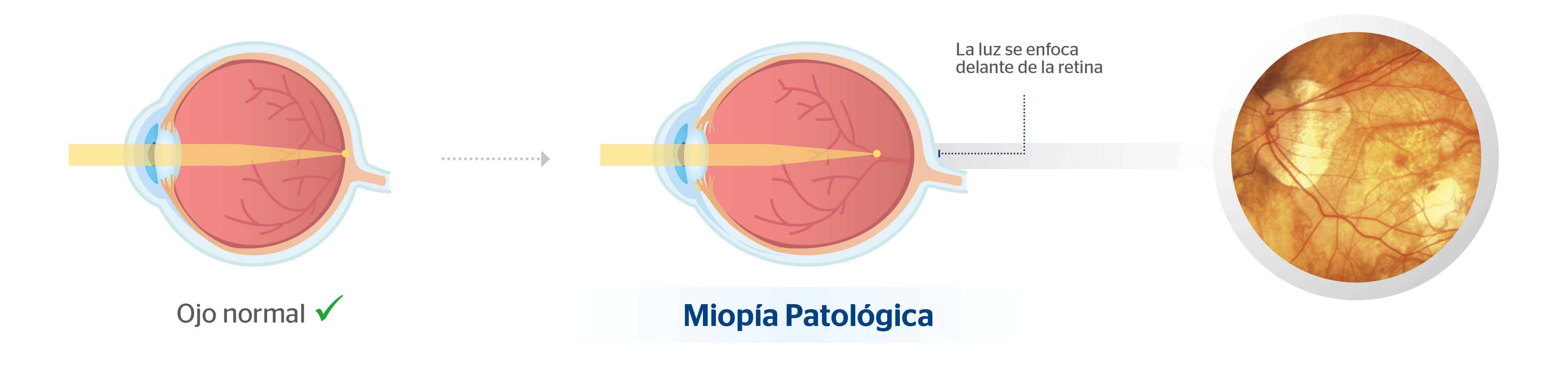 Ojo normal y ojo con miopía patológica