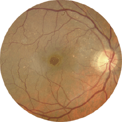 Fondo de ojo con agujero macular