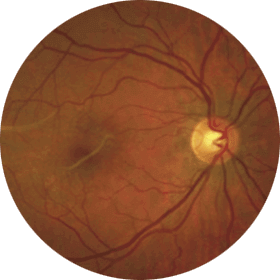 Fondo de ojo con membrana epirretiniana