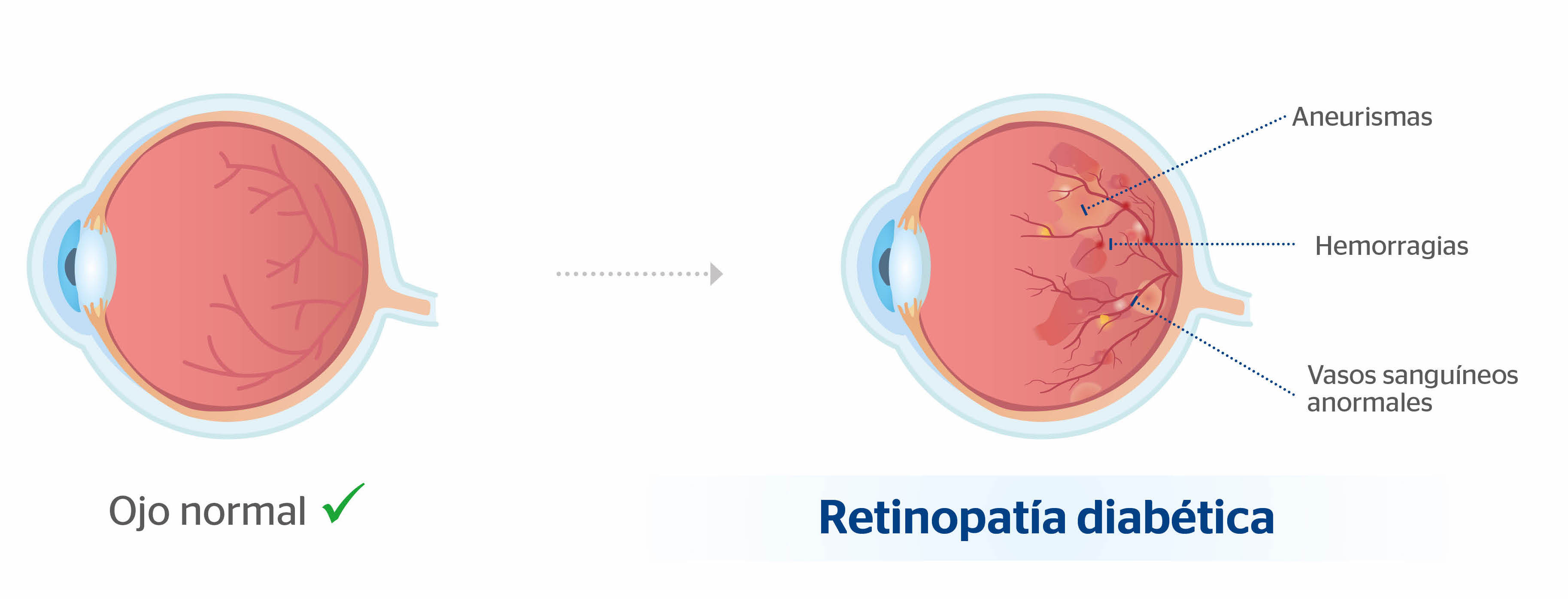 Ojo normal y ojo con retinopatía diabética